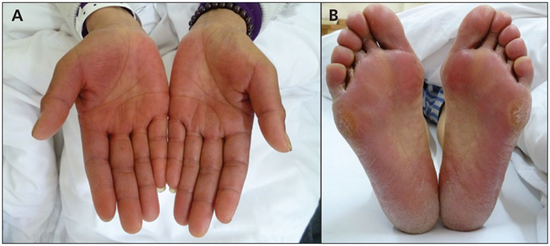 Turmeric reduces chemotherapy-induced palmar-plantar syndrome.